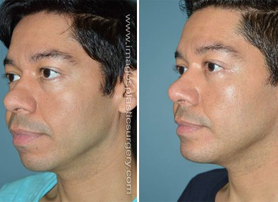 Before and after chin implant male patient left 3/4 side