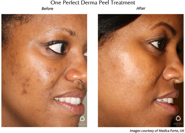 Before and after derma peel female patient right side