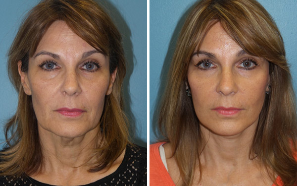 Before and after facelift female patient Imagos Plastic Surgery