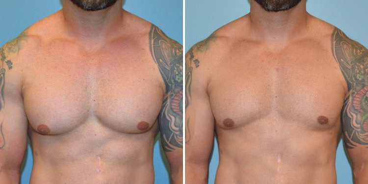 Before and after gynecomastia front view
