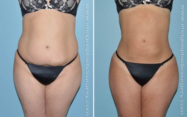 Before and after liposuction female patient Imagos Plastic Surgery