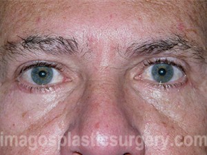 After eyelid surgery male patient front view case 4012