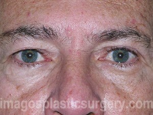 Before eyelid surgery male patient front view case 4012