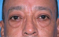eyelid surgery male patient front view case 4015
