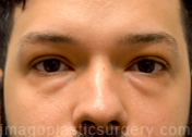 Before eyelid surgery male patient front view case 4047