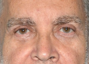 After eyelid surgery male patient front view case 4055