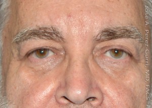 Before eyelid surgery male patient front view case 4055