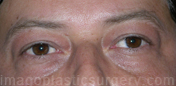 Before eyelid surgery male patient front view case 4078