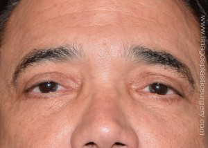After eyelid surgery male patient front view case 4088
