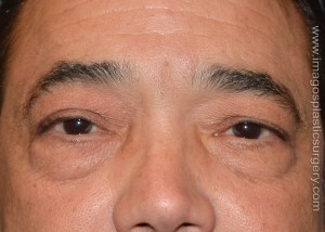 Before eyelid surgery male patient front view case 4088