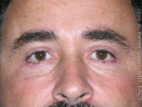 After eyelid surgery male patient front view case 4098