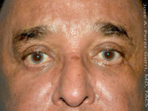 After eyelid surgery male patient front view case 4107