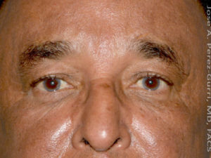 Before eyelid surgery male patient front view case 4107