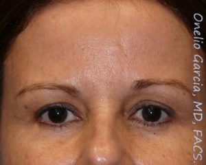 after front view botox of female patient 3182