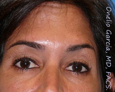 after front view botox of female patient 3190