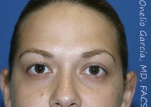before front view botox of female patient 3204