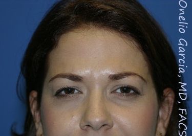 after brows down view botox of female patient 3204