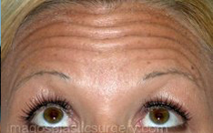 before brows up view botox of female patient 3214