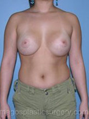 after front view breast augmentation of female patient 2663