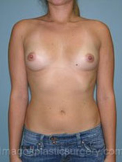 before front view breast augmentation of female patient 2672