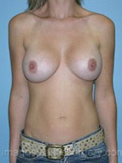 after front view breast augmentation of female patient 2676