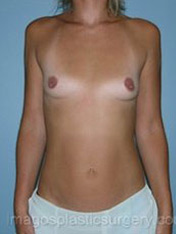 before front view breast augmentation of female patient 2676