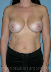 before front view breast augmentation of female patient 2708