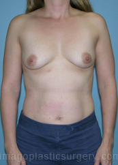 after front view breast augmentation of female patient 2708