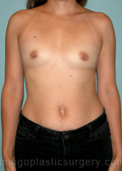 after front view breast augmentation of female patient 2744