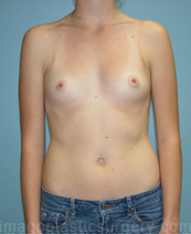 before front view breast augmentation of female patient 2759