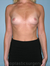 before front view breast augmentation of female patient 2788