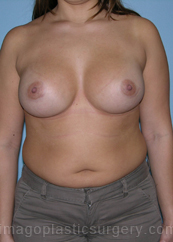 after front view breast augmentation of female patient 2798