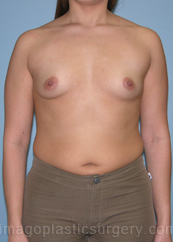 before front view breast augmentation of female patient 2798