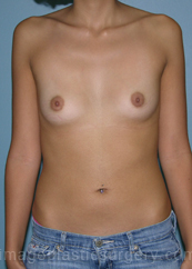 before front view breast augmentation of female patient 2832