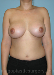 after front view breast augmentation of female patient 2845