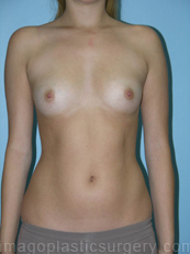 before front view breast augmentation of female patient 2998