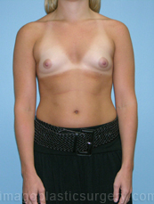 before front view breast augmentation of female patient 3030