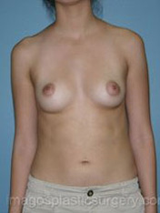 before front view breast augmentation of female patient 3033