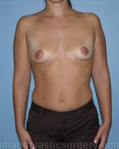 before front view breast augmentation of female patient 3037