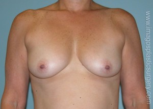 before front view breast augmentation of female patient 3041