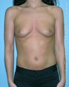 before front view breast augmentation of female patient 3056