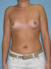 before front view breast augmentation of female patient 3065