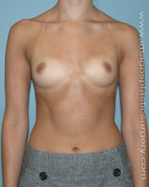 before front view breast augmentation of female patient 3098