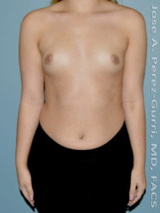 before front view breast augmentation of female patient 3104