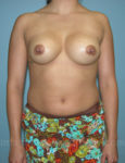 after front view breast implant revision of female patient 3343