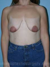 before front view breast lift of female patient 3588