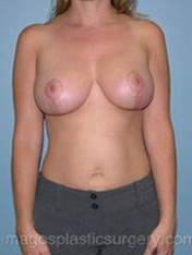 after front view breast lift of female patient 3593