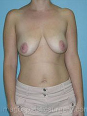 before front view breast lift of female patient 3593