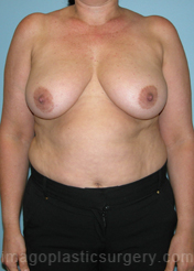 before front view breast lift of female patient 3599