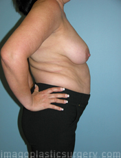 before right side view breast lift of female patient 3599